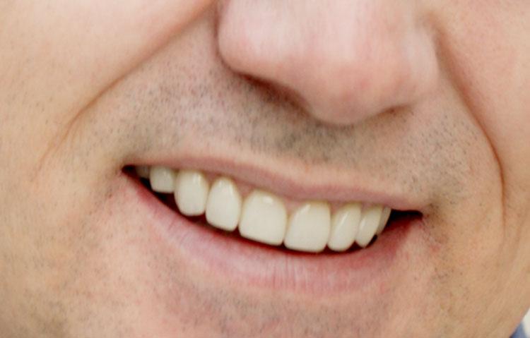 Man showing his straightened teeth