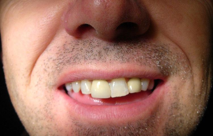 Man showing his unstraightened teeth