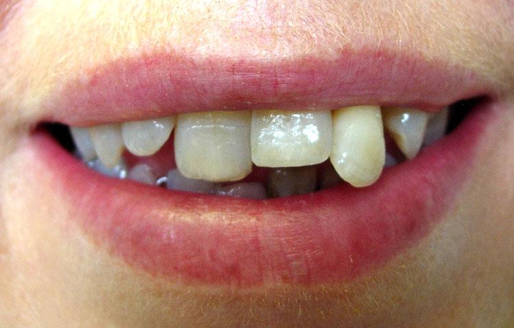 Close up of teeth before dental work