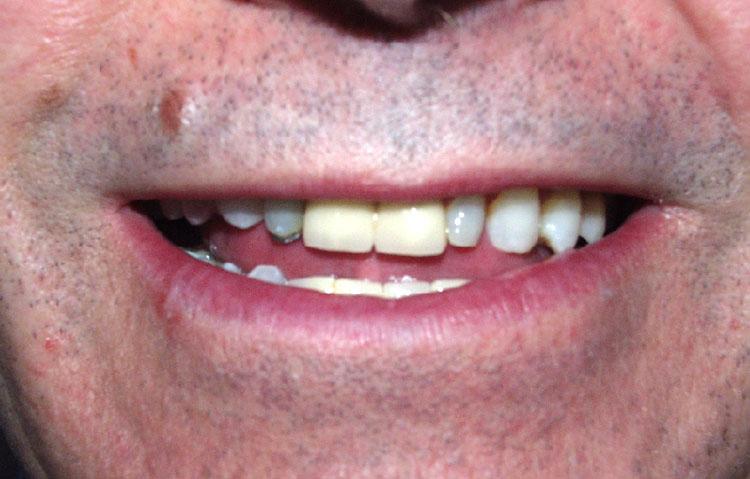 Close up of teeth requiring dental work