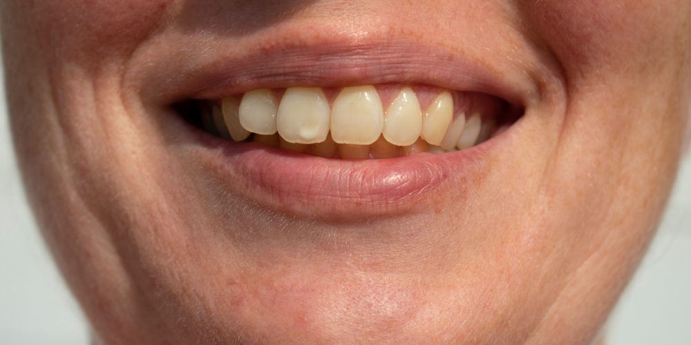 women smiling tooth spot