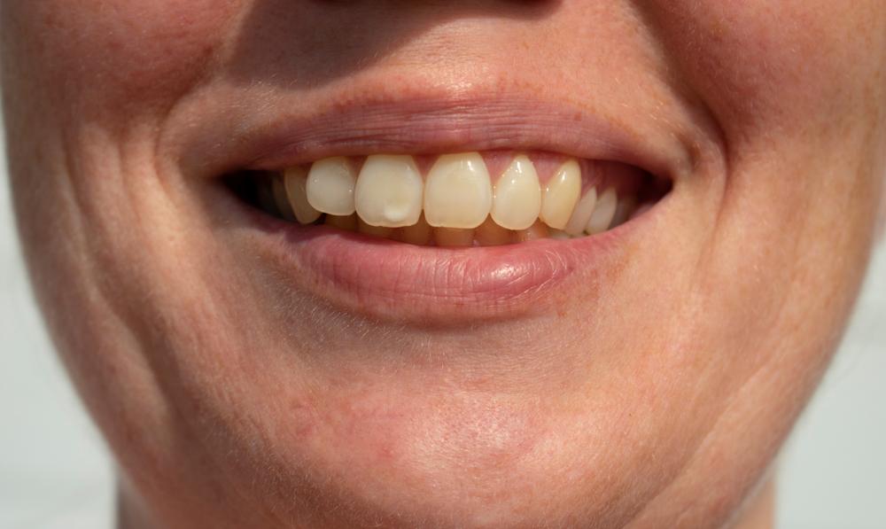 women smiling tooth spot