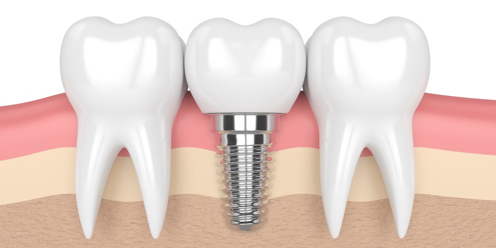3d,Render,Of,Teeth,With,Dental,Implant,In,Gums,Over dental implants