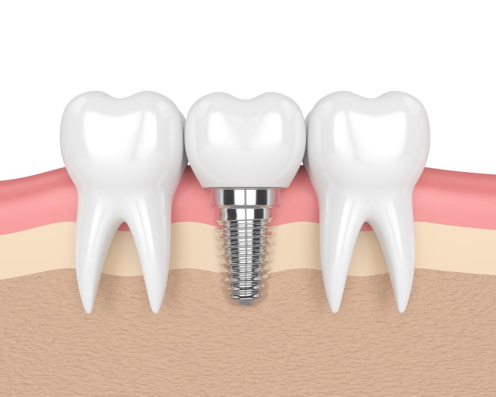 3d,Render,Of,Teeth,With,Dental,Implant,In,Gums,Over dental implants