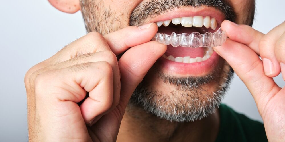 Unrecognizable,Dark-haired,Man,With,Beard,Putting,On,Transparent,Dental,Retainer Unrecognizable Dark haired Man With Beard Putting On Transparent Dental Retainer