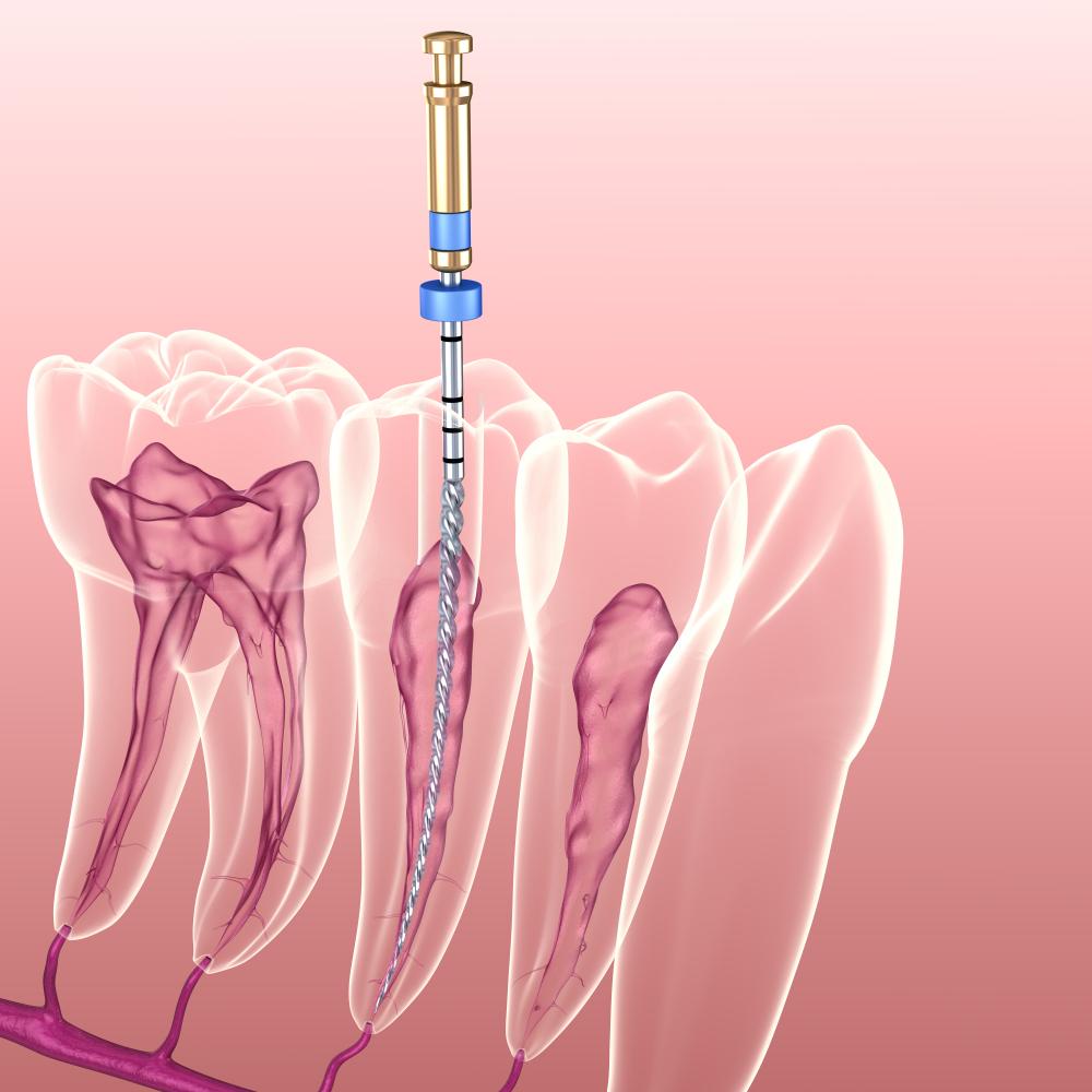 Endodontic Root Canal Treatment Process. Medically Accurate Tooth 3d Illustration