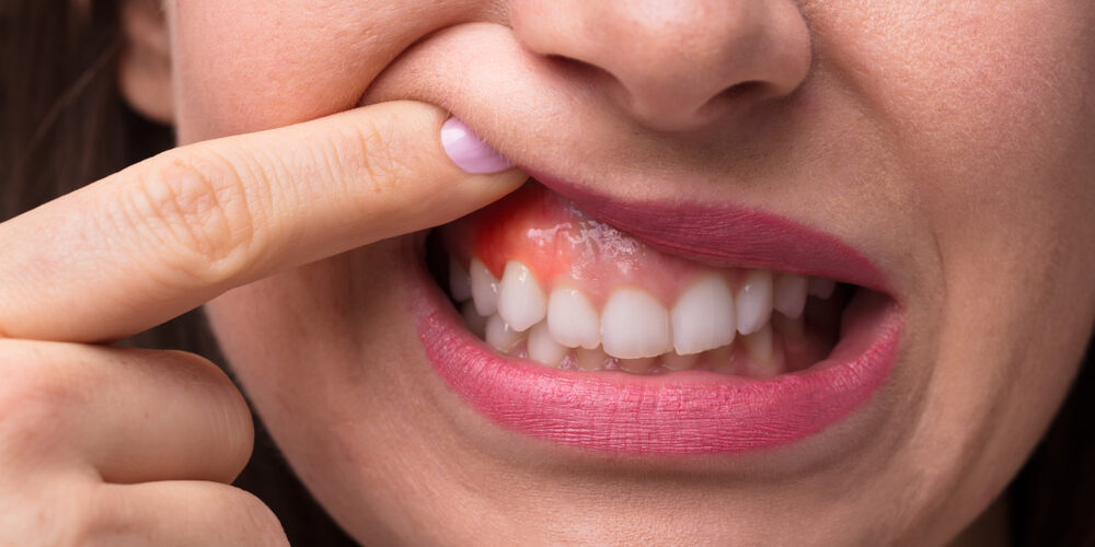 Close-up,Of,A,Woman’s,Finger,Showing,Swelling,Of,Her,Gum Close up Of A Woman's Finger Showing Swelling Of Her Gum